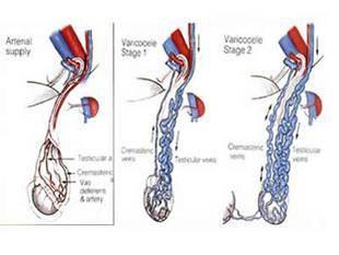 男性一旦患上精索静脉曲张会有哪些危害呢