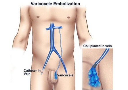 男性患有精索静脉曲张生活上注意什么